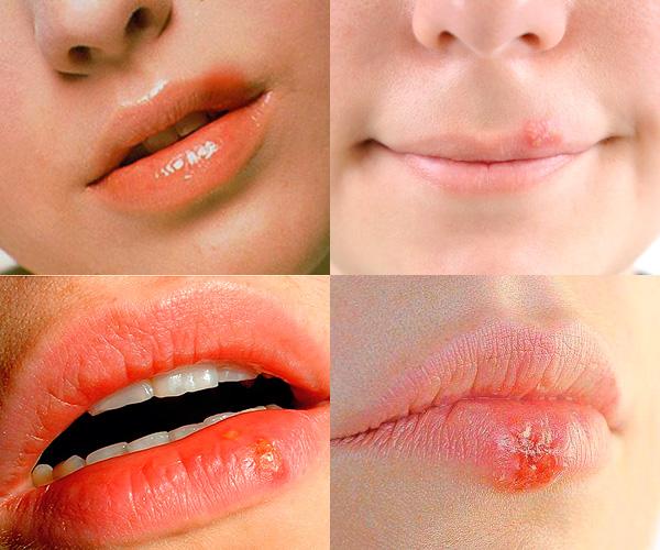 Wie sieht Herpes auf den Lippen aus?