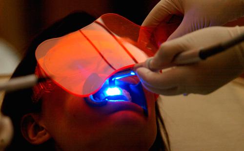 Лазерно избелване на зъби
