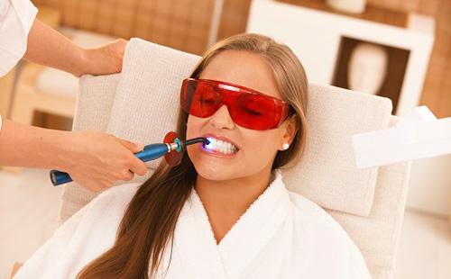 Sbiancamento dentale dei denti