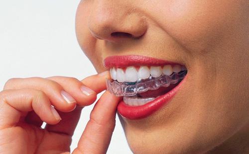 Protecció bucal per blanquejar les dents