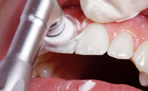 Profesionální bělení zubů
