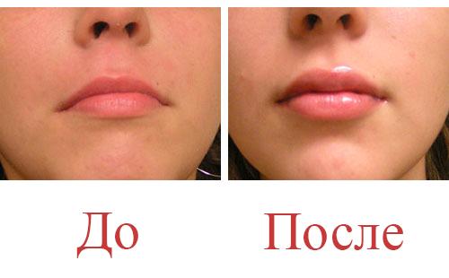 Устни преди и след процедурата
