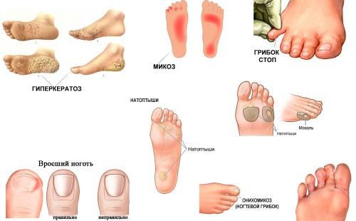 Hyperkeratose van de voeten, mycose van de voeten, schimmel van de voeten, likdoorns, nagel schimmel, ingegroeide nagel