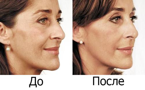 En smuk kvinde blev endnu smukkere efter anvendelse af Botox-apoteket