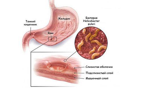 La figura mostra il meccanismo di formazione delle ulcere allo stomaco