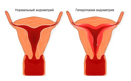 Vzorec proliferace endometriální tkáně