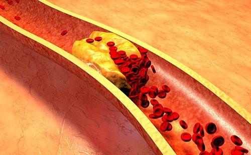 Arterielle Cholesterinplakette