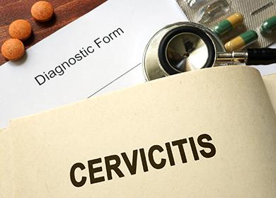 Cervicitis des Gebärmutterhalses